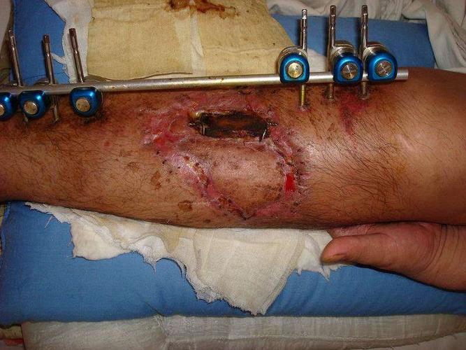 骨质外露肌肉坏死洛阳皮瓣修复