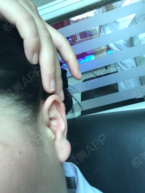 取完耳软骨的耳朵也毁了挛缩很严重超级严重完全变形了医院里面的技术