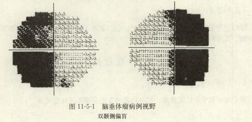 视交叉病变