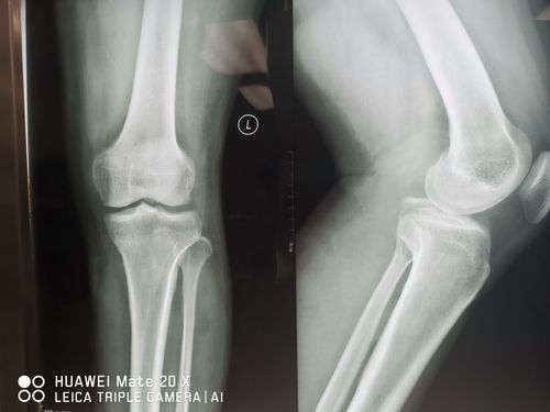 关节镜后交叉韧带止点髁间棘撕脱骨折endobutton重建半月板损伤缝合