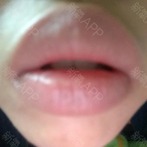 上唇翘起来很厚