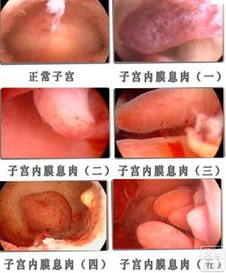而"子宫息肉"是慢性宫颈炎