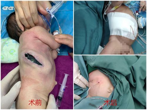 吓人出生仅15天女婴感染食肉菌上身一半几乎被吃掉