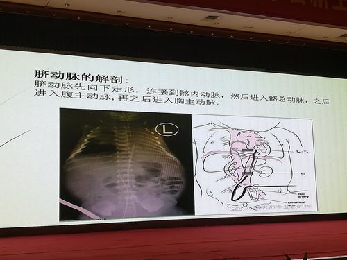 脐动脉置管
