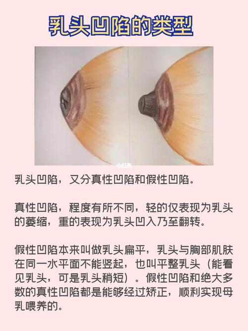 苏州金牌月嫂经验分享:乳头凹陷怎么办?