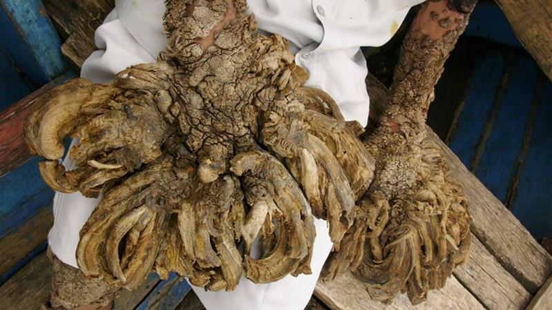 印尼"树人",手脚长出树根,饱受折磨数十年_迪德