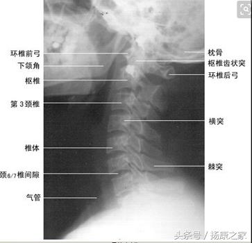 你知道如何读自己颈椎的x光片吗?