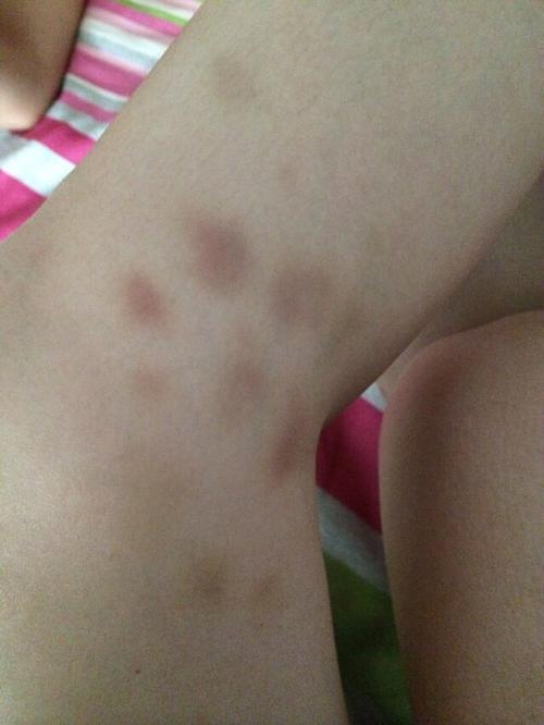 可能是血液方面的问题,血小板减少等,最严重是白血病,建议你快去