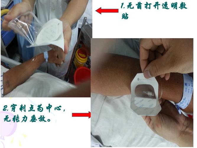 无菌打开透明敷 贴 2.穿刺点为中心, 无张力垂放.