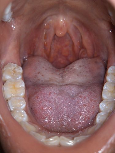 帮我看看我这个扁桃体是不是该割掉啊