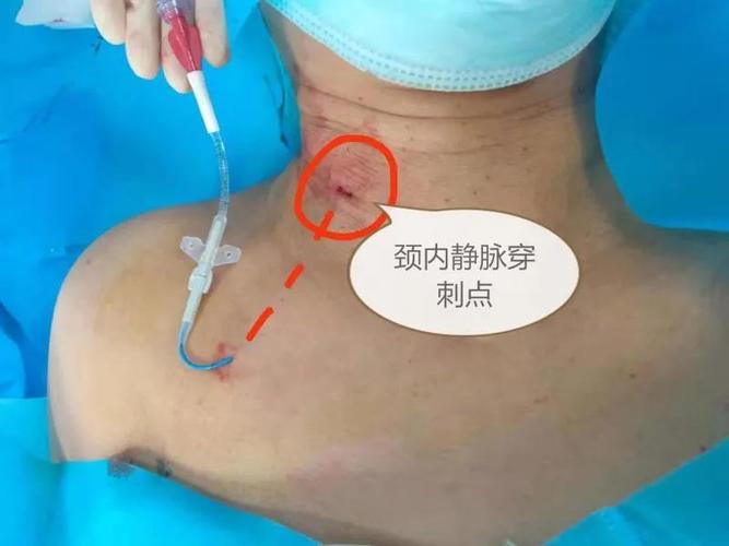 条条大路通"罗马"│潍坊市人民医院完成首例隧道式颈内静脉置管术