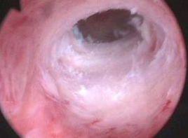 创伤性宫腔粘连