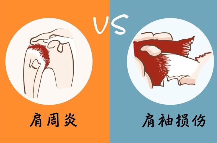 此外,肩周炎更明显的症状就是肩膀疼痛,大多数都在晚上发病,只要合理