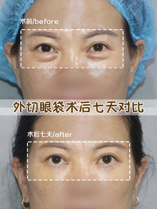 外切祛眼袋七天对比