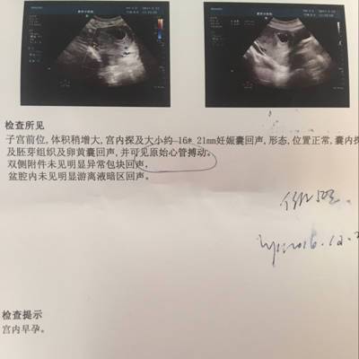 怀孕五十天这样的孕囊大小正常吗