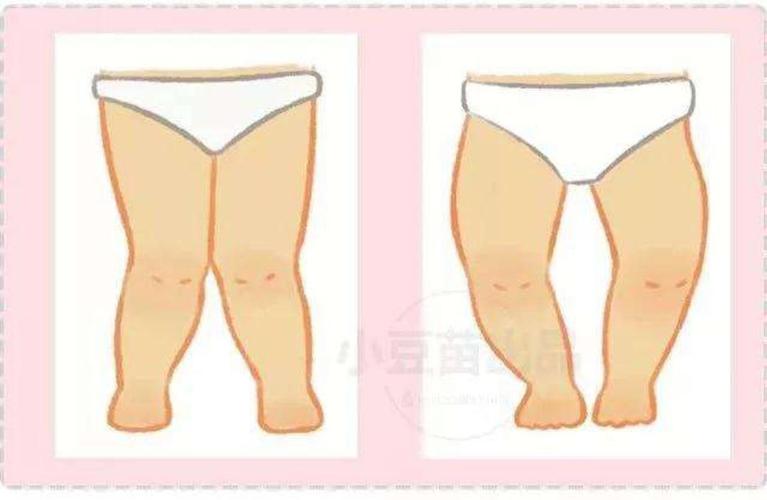 x型腿 开始行走后,由于骨质软化,因负重可出现下肢弯曲严重膝外翻 o型