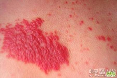 常见血管瘤的病因有哪些呢