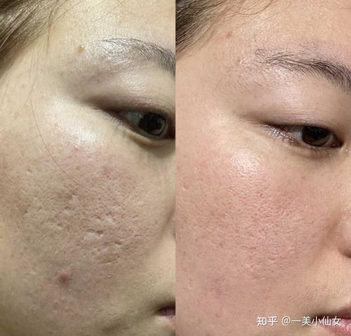 投稿二氧化碳点阵激光