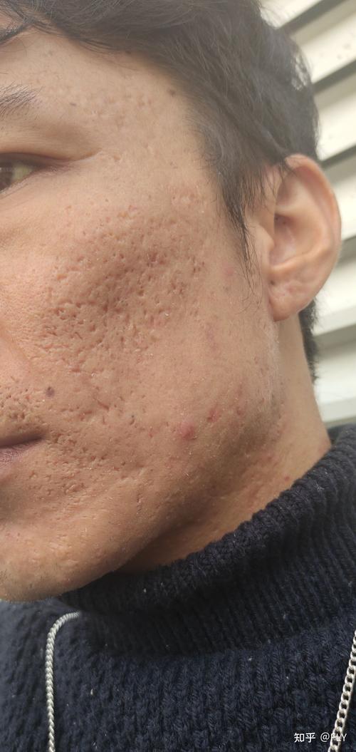 十二年痘坑,现在准备试一试