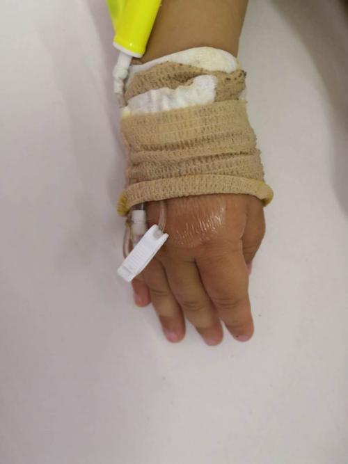 原先的固定方法存在一些弊病,首先,可视性差,弹力绷带会影响输液部位