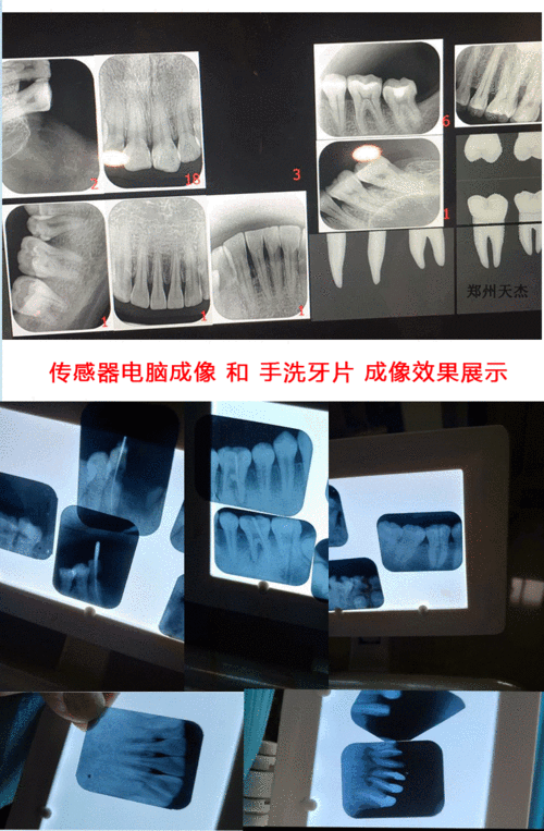 天杰牙片机x光机口腔高清高频便携式拍片机定位器传感器设备拍片机8