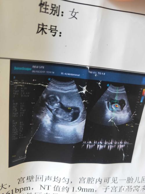 3个月nt检查已过,,请各位宝妈看看是男