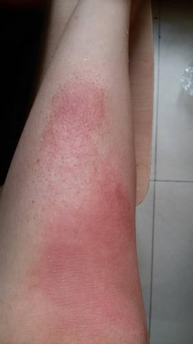 问:有点痒 大片红 还有小疙瘩 面积在扩散,是过敏吗?