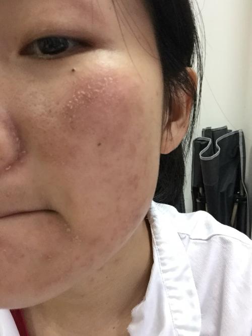 从没想过晒伤竟会发生在我脸上,真的哭了!