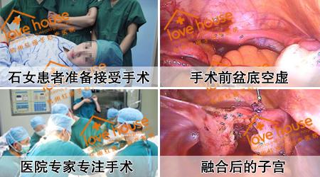 杭州红房子石女之母正准备给患者开展无子宫手术