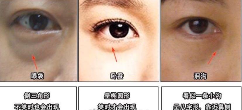 听说还有人分不清自己眼下的是眼袋,卧蚕还是泪沟