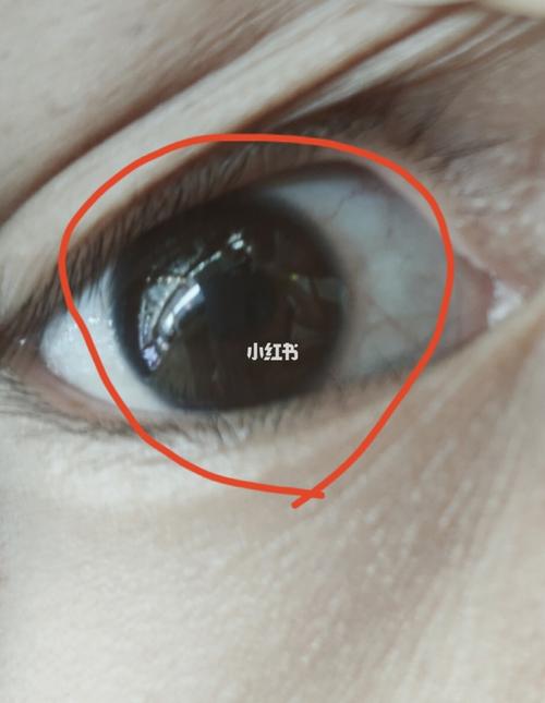 近视眼睛的眼珠都有一层白色的膜,不近视的都是很透彻