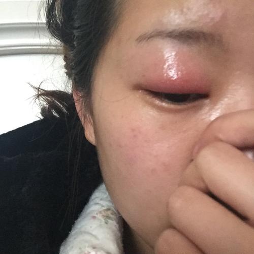 不知道是食物过敏还是碰了什么东西,当时就觉得眼睛有些痒