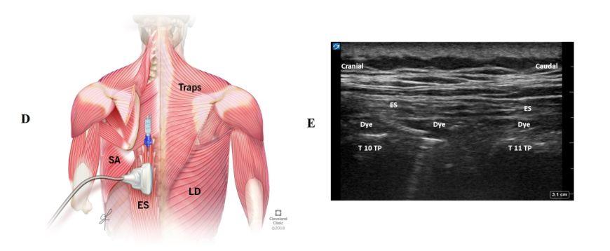 超声引导竖脊肌平面阻滞科普第二弹