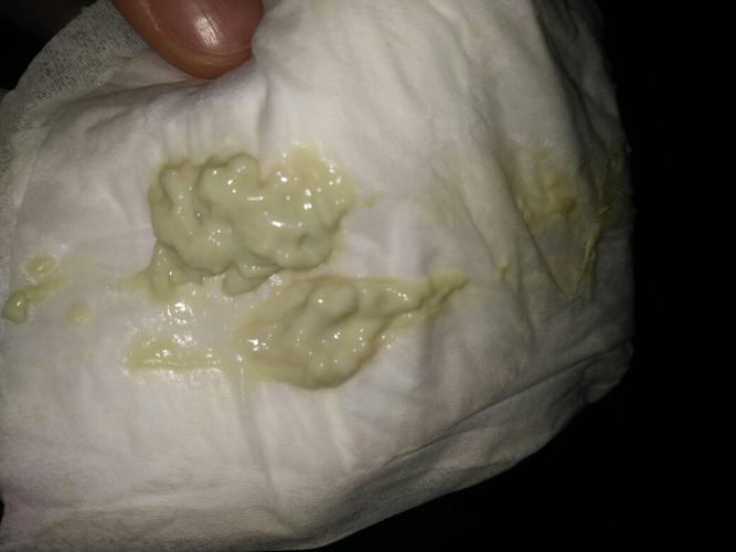 我今年17岁,白带是青绿色的,像豆腐渣一样,量还特别多