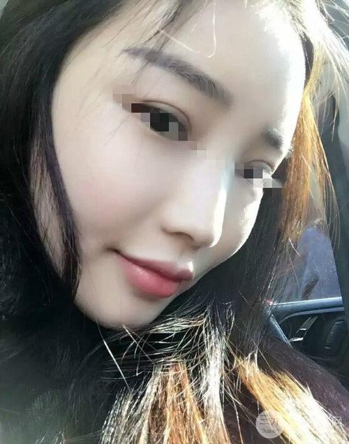 全脸脂肪填充效果图