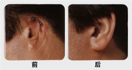 耳部整形前后对比照 点击咨询耳部专家