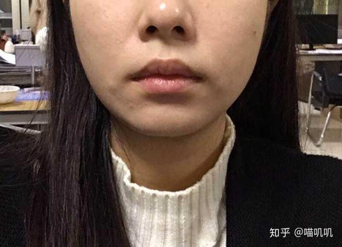 为什么嘴巴两边嘴角会有凸出来的肉肉看整体面相的话比看这个局部更