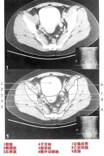 女性盆腔ct解剖