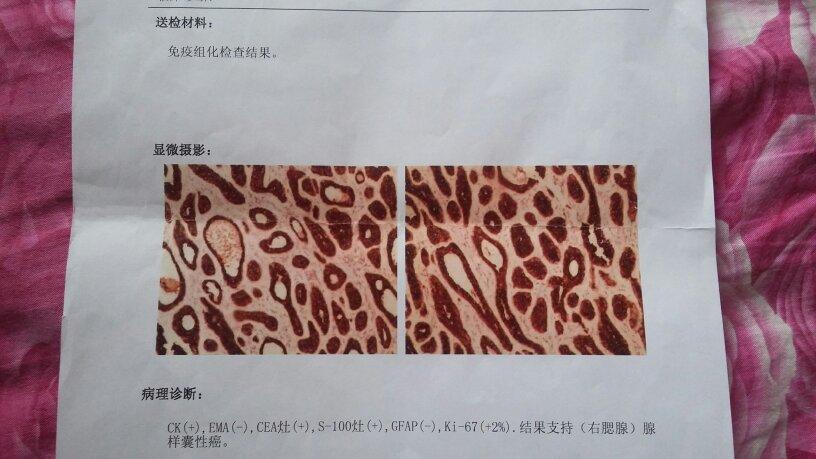 我老公于9月8号做的腮腺混合瘤手术,术后病理报腺样囊