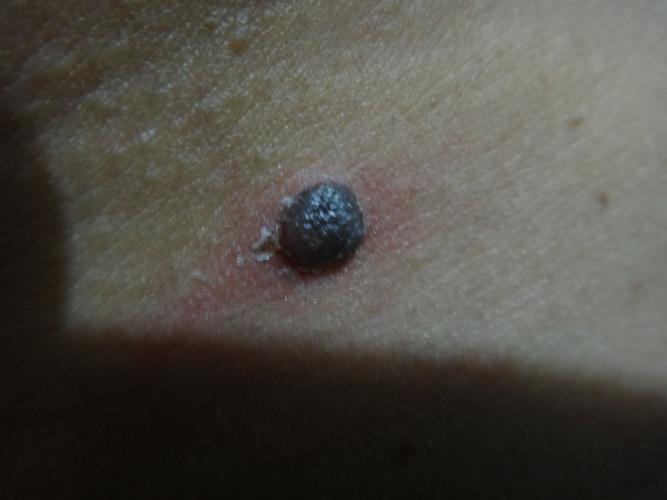 怎么去掉黑痣的方法 痣应该如何治疗用药