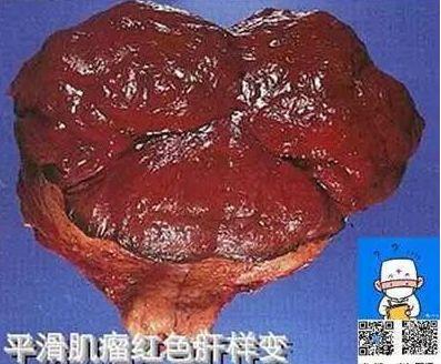 它都是子宫肌瘤慢性缺血的一种表现;而另外一种红性变性,它是子宫肌瘤