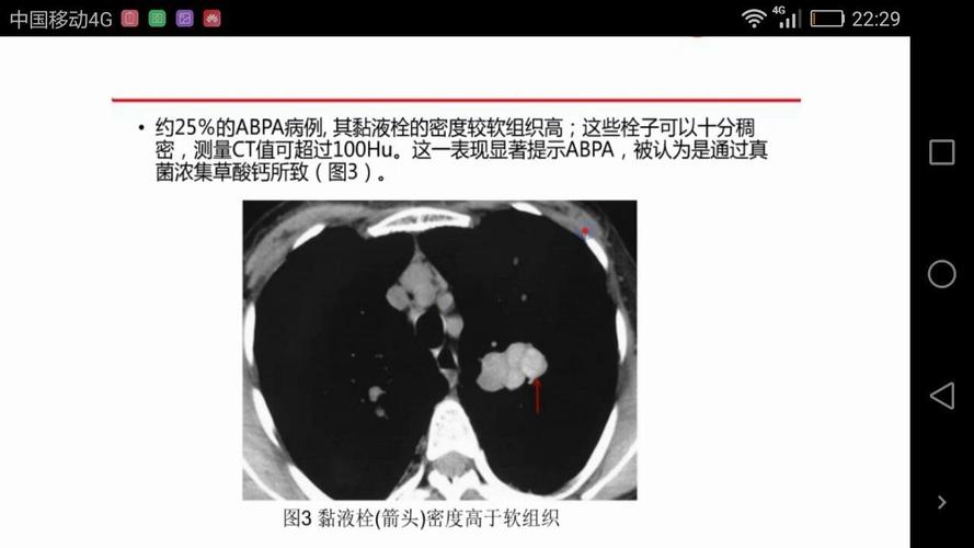 支气管扩张系列病例——呼吸影像群,余杭方建庆