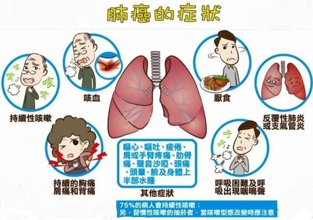肺结节就是第一癌症?医生提醒:远离8大因素,肺才安全
