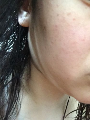 亲爱的宝妈们,我怀孕九周,脸上长了很多这样的红疹,哪