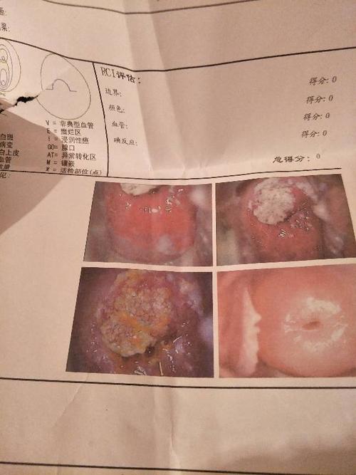 宫颈上长白色小点点啥事啥病 宝宝知道