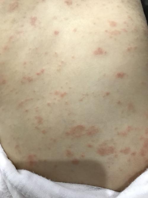 特异性皮炎?湿疹?开了洗的,吃的,擦的.不管用