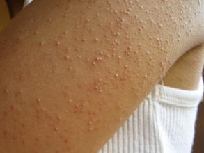 毛周角化症患者必读—病因 - 角化症 - 重庆华肤医院