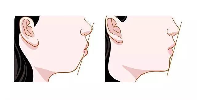 侧面图:三庭,正常审美和深覆合的情况