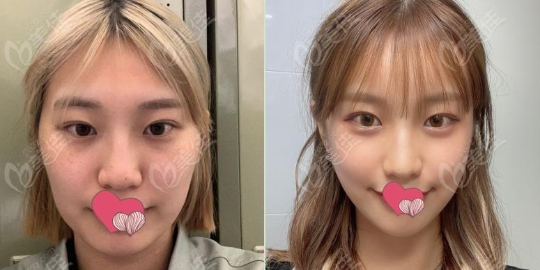 韩国哪个整形医院磨颧骨好1整形林宗宇医生的削骨技术就挺不错