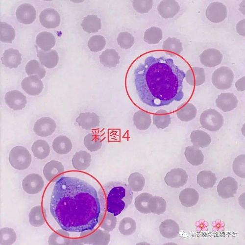 04 「幼稚单核细胞」 形态特征:胞体类圆形或不规则形;胞质丰富,灰